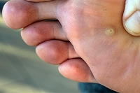 Plantar Warts in Children