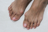 Causes of a Bunion and How to Manage It