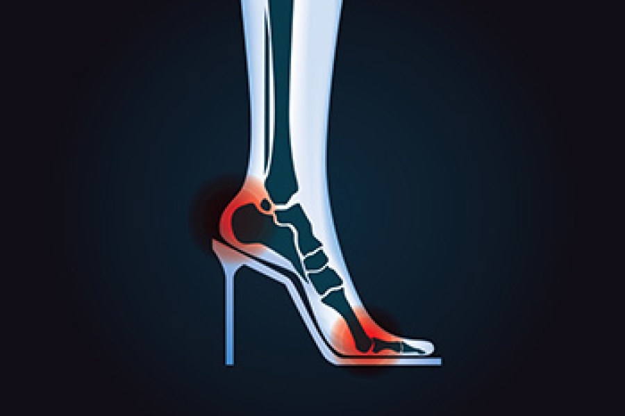 Heels are not Always Good for the Sole - PhysioTec