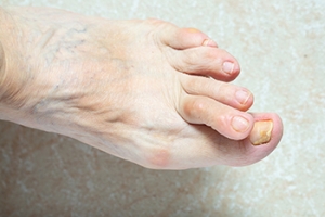 Hammertoe Causes Toes to Take a Wrong Turn