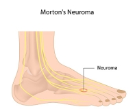 Exercises for Morton’s Neuroma