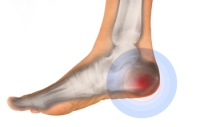 Causes and Symptoms of Bursitis in the Heel