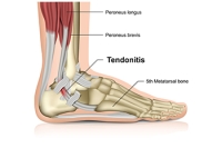 Understanding an Achilles Tendon Injury