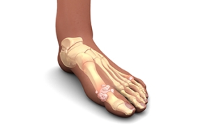 Symptoms and Risk Factors of Gout