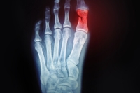 Important Facts About Broken Toes