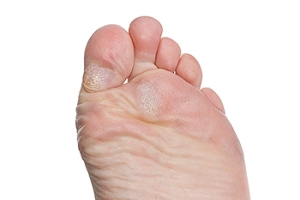 Possible Causes of Hard Skin on the Feet