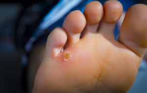 All About Corns on the Feet