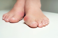 Effective Stretches for Bunions