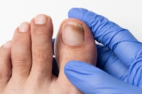 Toenail Fungus and Prevention Methods