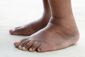 Swollen Feet in the Elderly