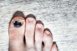 Painful Runner&#039;s Toe