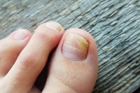Ways to Avoid Toenail Fungus Infections